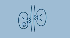 Adrenocortical Carcinoma