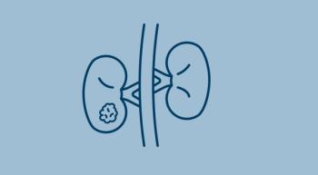 Blue line illustration on a lighter blue background of kidneys with a tumor on the left kidney