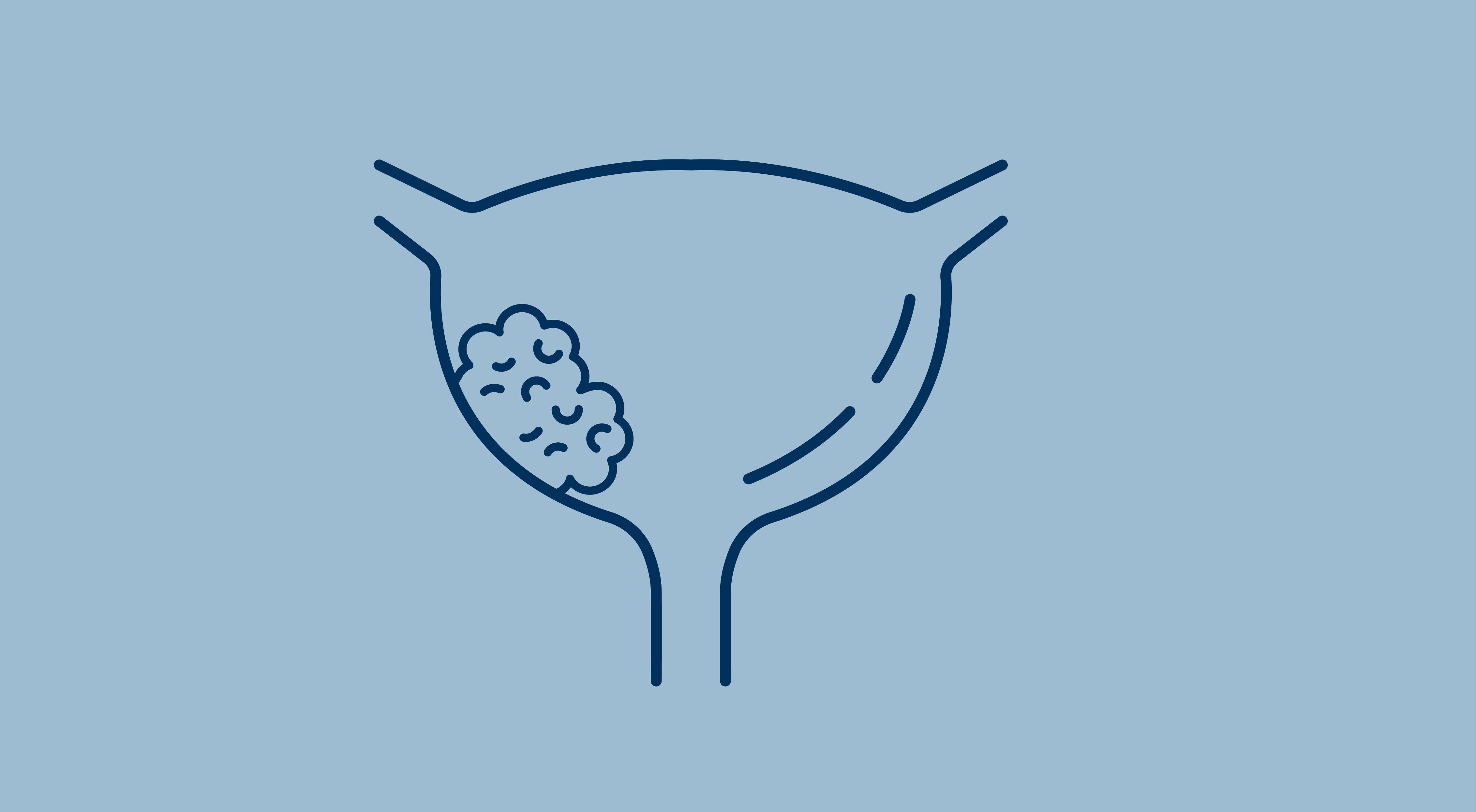 line illustration of a bladder with a tumor