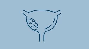 line illustration of a bladder with a tumor