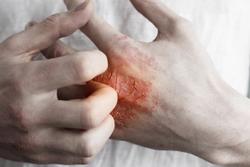 Single Nucleotide Polymorphism Genotyping Could Predict Severe Radiation Dermatitis in Breast Cancer