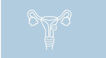 ovarian cancer
