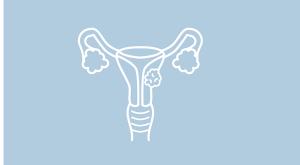 Niraparib/Bevacizumab Combo Elicits Promising Responses in Advanced Ovarian Cancer, Regardless of Biomarker Status