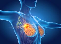  Forgoing Select Lymph Node Dissection Linked With Superior Outcomes in Early-Stage Breast Cancer