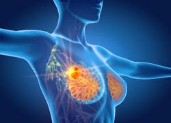 Forgoing Select Lymph Node Dissection Linked With Superior Outcomes in Early-Stage Breast Cancer