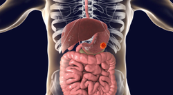 Trastuzumab Deruxtecan Continues to Elicit Encouraging Responses in Patients With Metastatic Gastric/GEJ Cancer