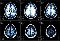 Patients With HER2+ Breast Cancer and Brain Metastases Achieve Better OS With Tucatinib Triplet Regimen