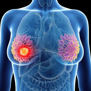 Graphic of a breast with a tumor