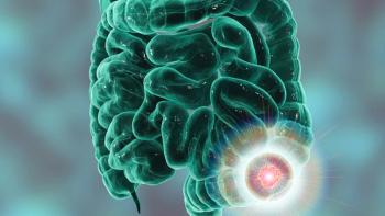 Graphic of the GI tract with a colorectal tumor