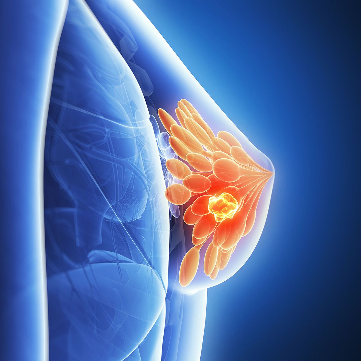 Graphic of a breast with tumors