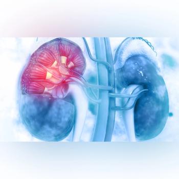 Image of a kidney with renal cell carcinoma