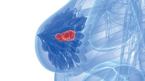 Earlier Adjuvant Chemotherapy Benefits Patients With TNBC