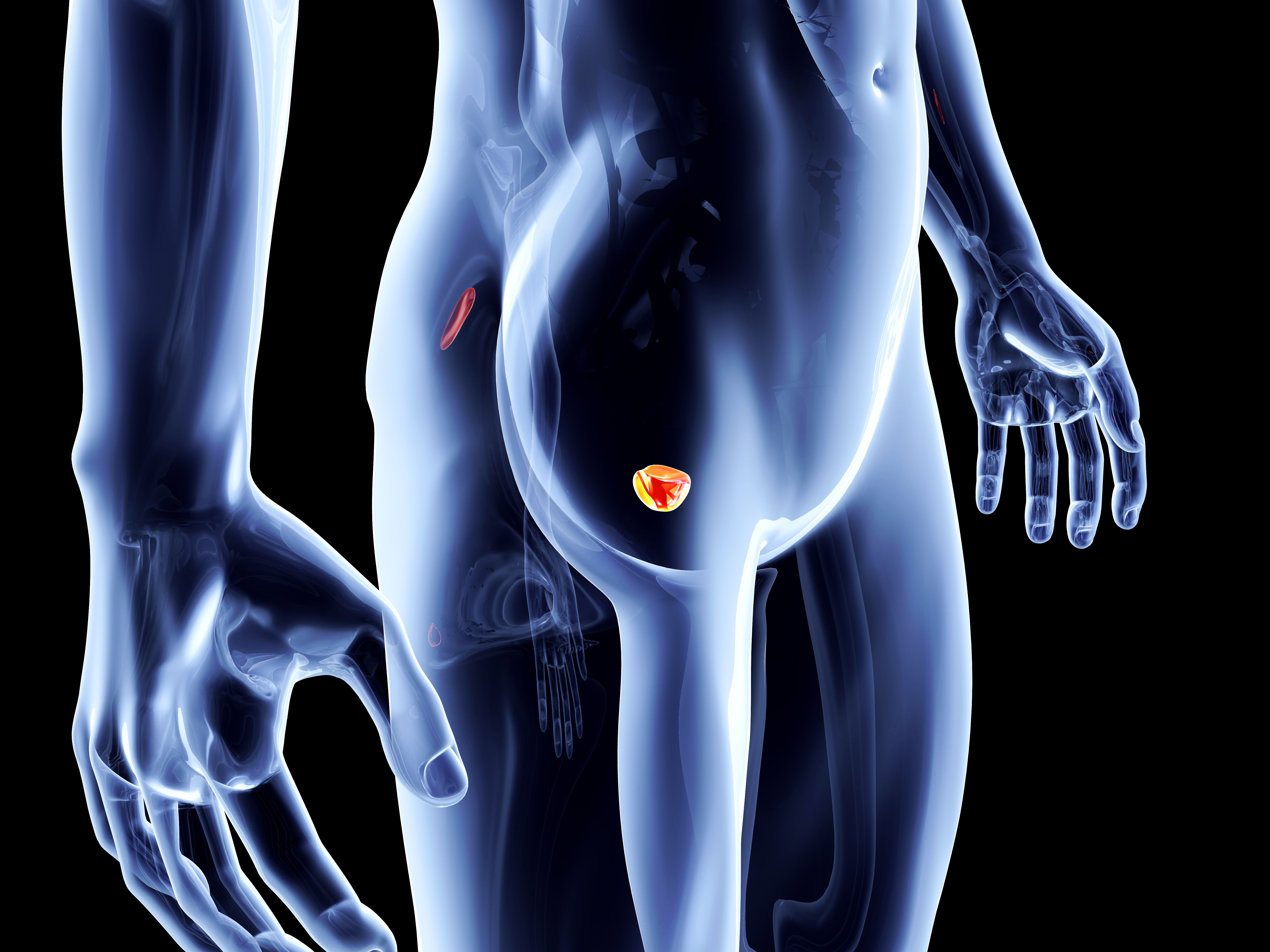 Prostate Cancer Heat Map