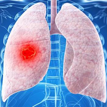 Anatomical image of a person with a tumor in their left lung