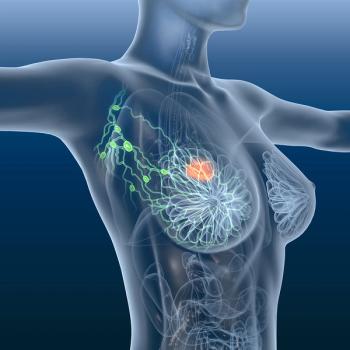 Anatomical image of a person with a breast tumor
