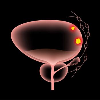 Anatomical graphic of the male genitourinary system with a tumor in the bladder