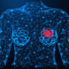 Graphic of a person with a breast tumor