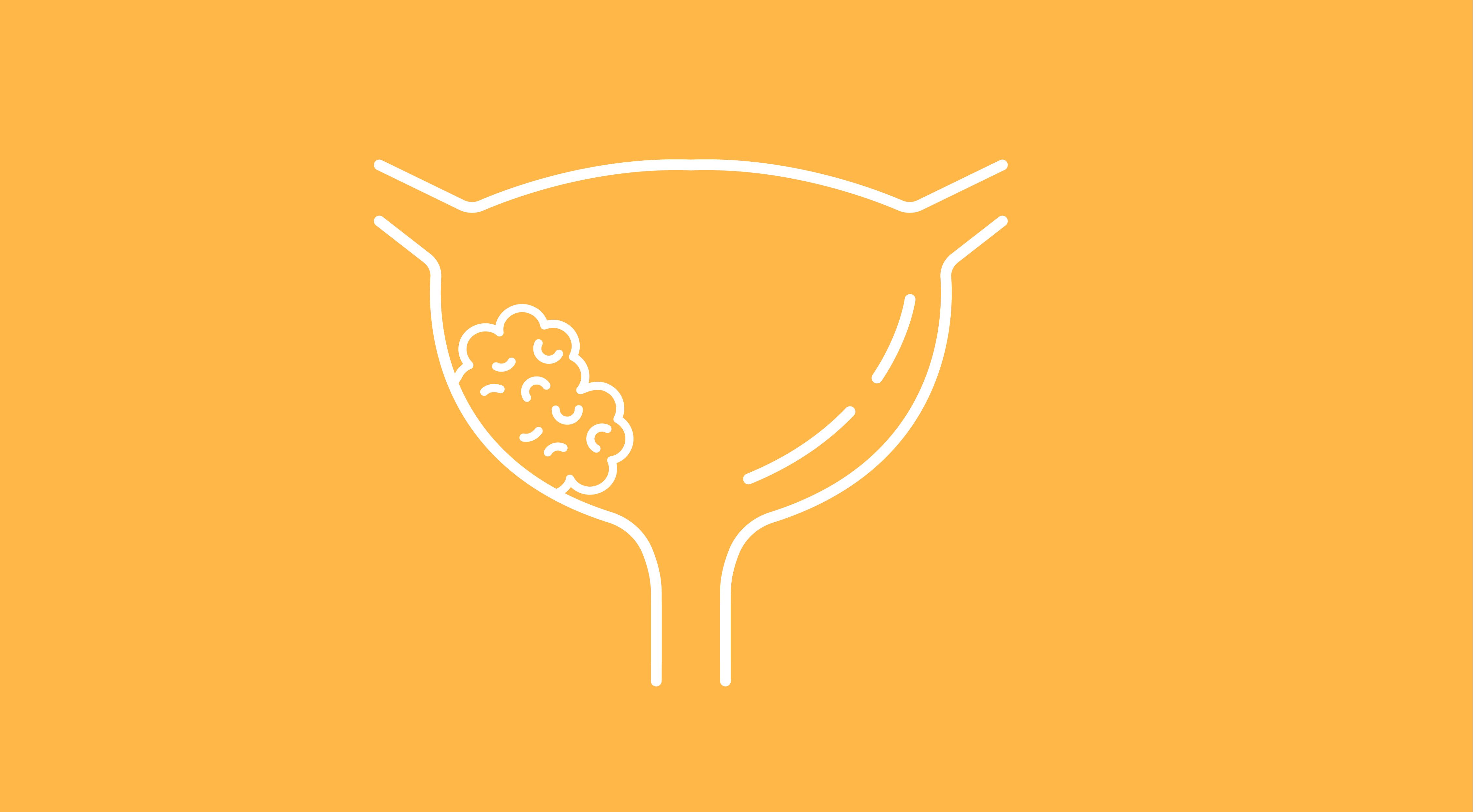 bladder cancer