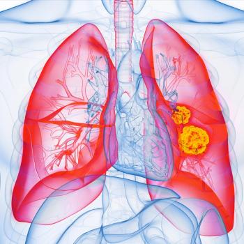 Image of a lung with tumors