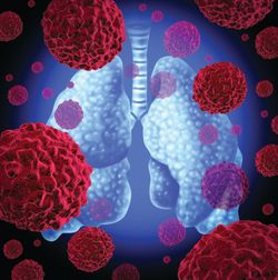 Pralsetinib Is Tolerable, Durable in RET Fusion+ NSCLC