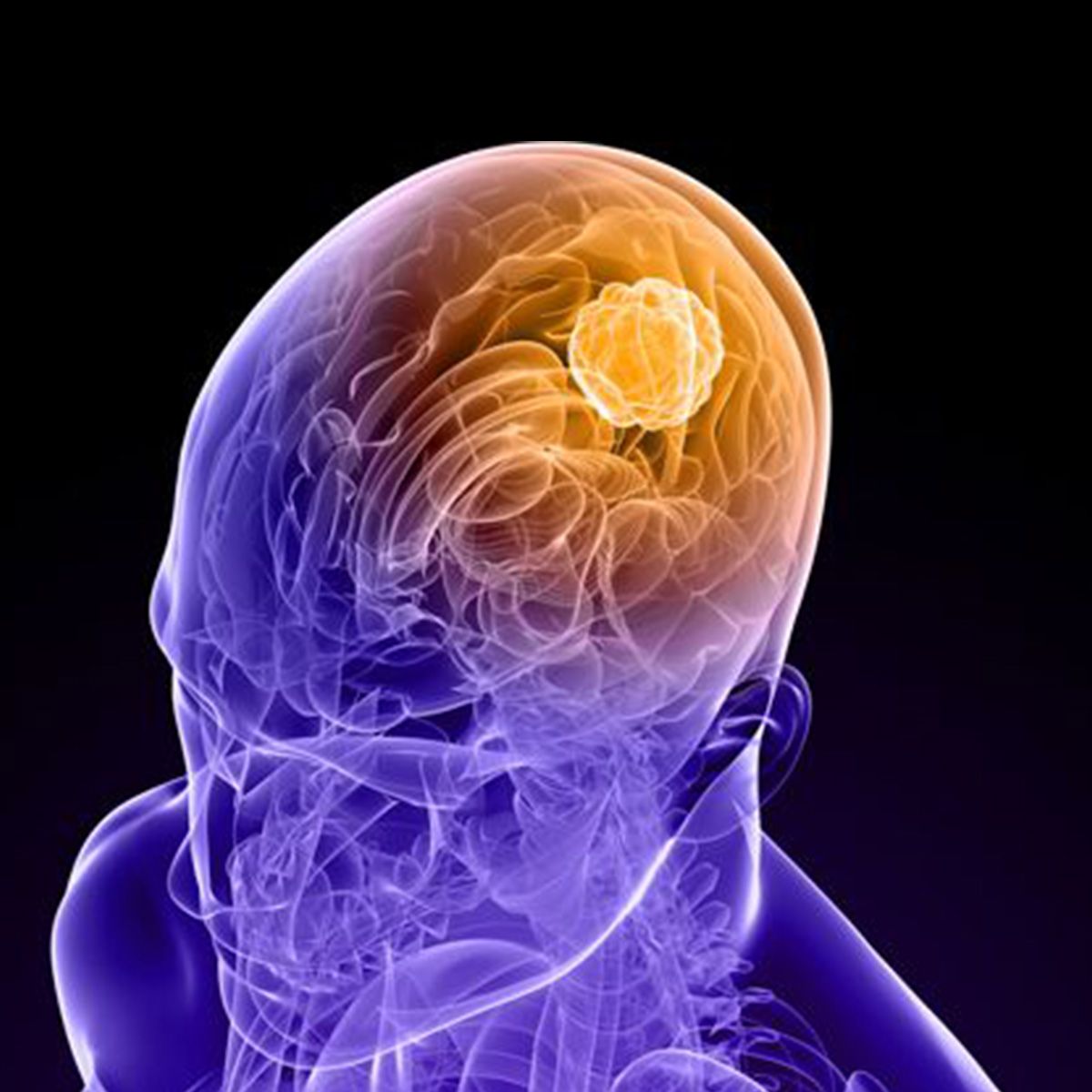 Anatomical aerial image of a person with a brain tumor