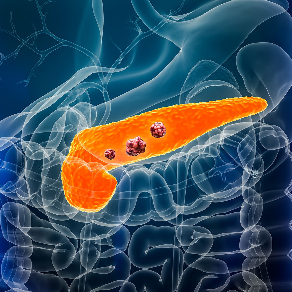 Anatomical image of a pancreas with tumors
