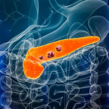 Anatomical image of a pancreas with tumors