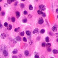 Daratumumab Approved Early by FDA for Multiple Myeloma | Oncology ...