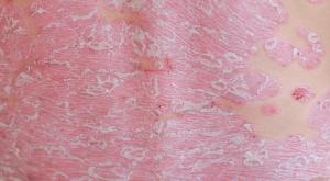 Dermatologic Adverse Events in Melanoma: What to Look Out For