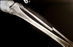 Bone-Protecting Agents Reduce Fracture Risk During Prostate Cancer Treatment