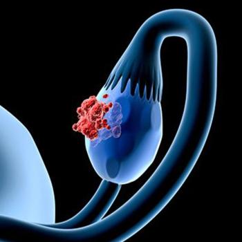 Image of an ovary with a tumor