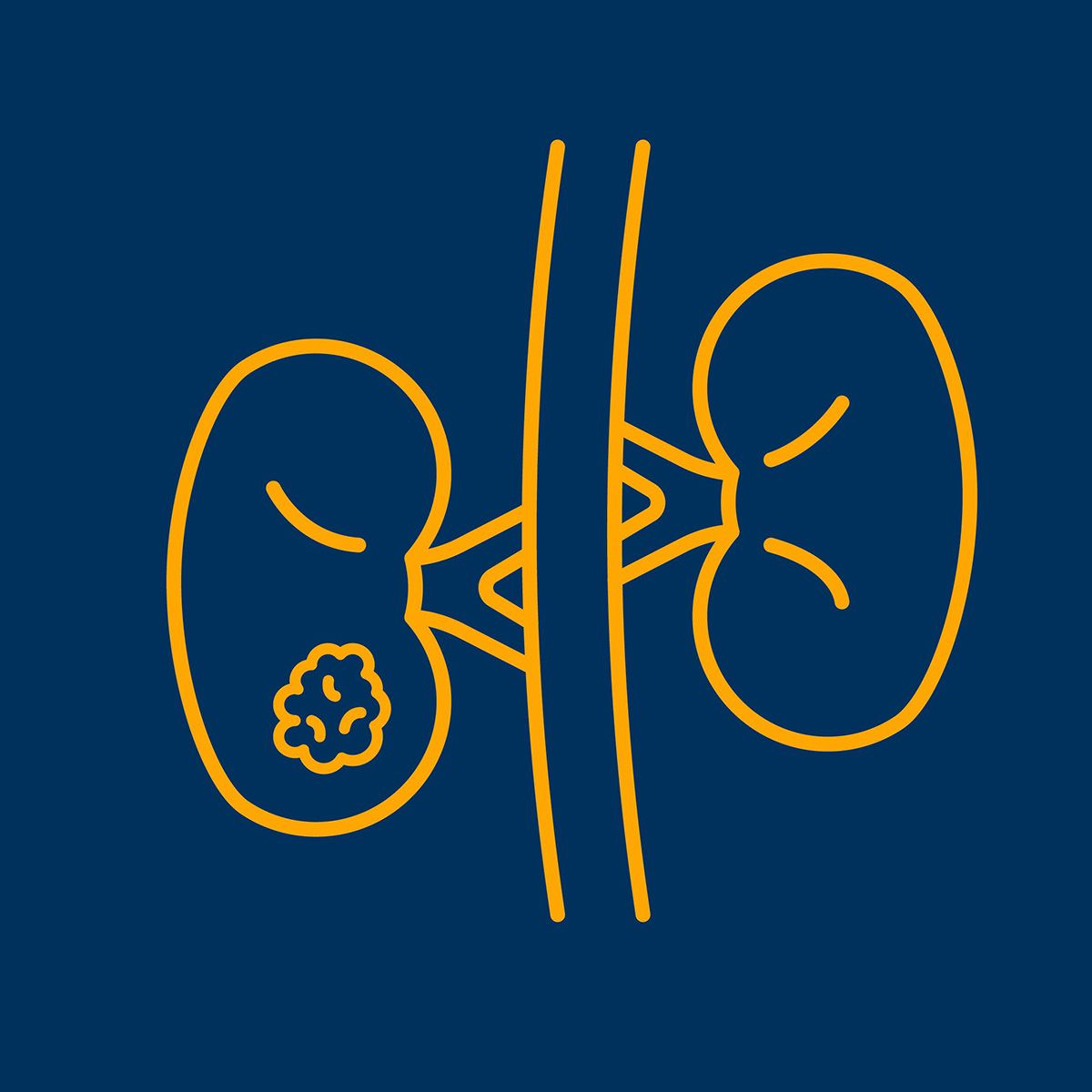 Line illustration of a pair of kidneys with a tumor on the left kidney