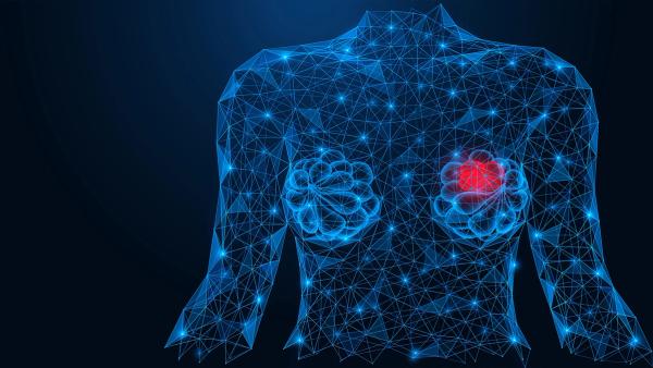 Graphic of a breast with a tumor