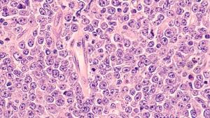 Image of lymphoma cells