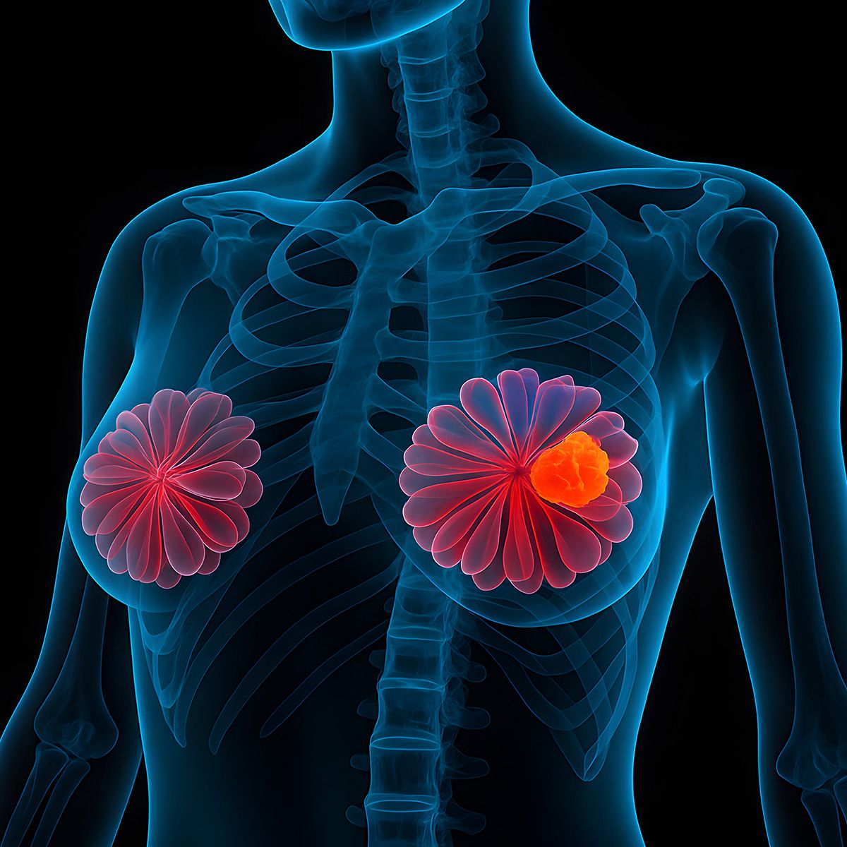 健康・医学 Breast Cancer First-Line T-DXd/Pertuzumab Yields Improved PFS in HER2+ mBC