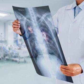 Photo of a healthcare worker holding an x-ray of lungs with tumors