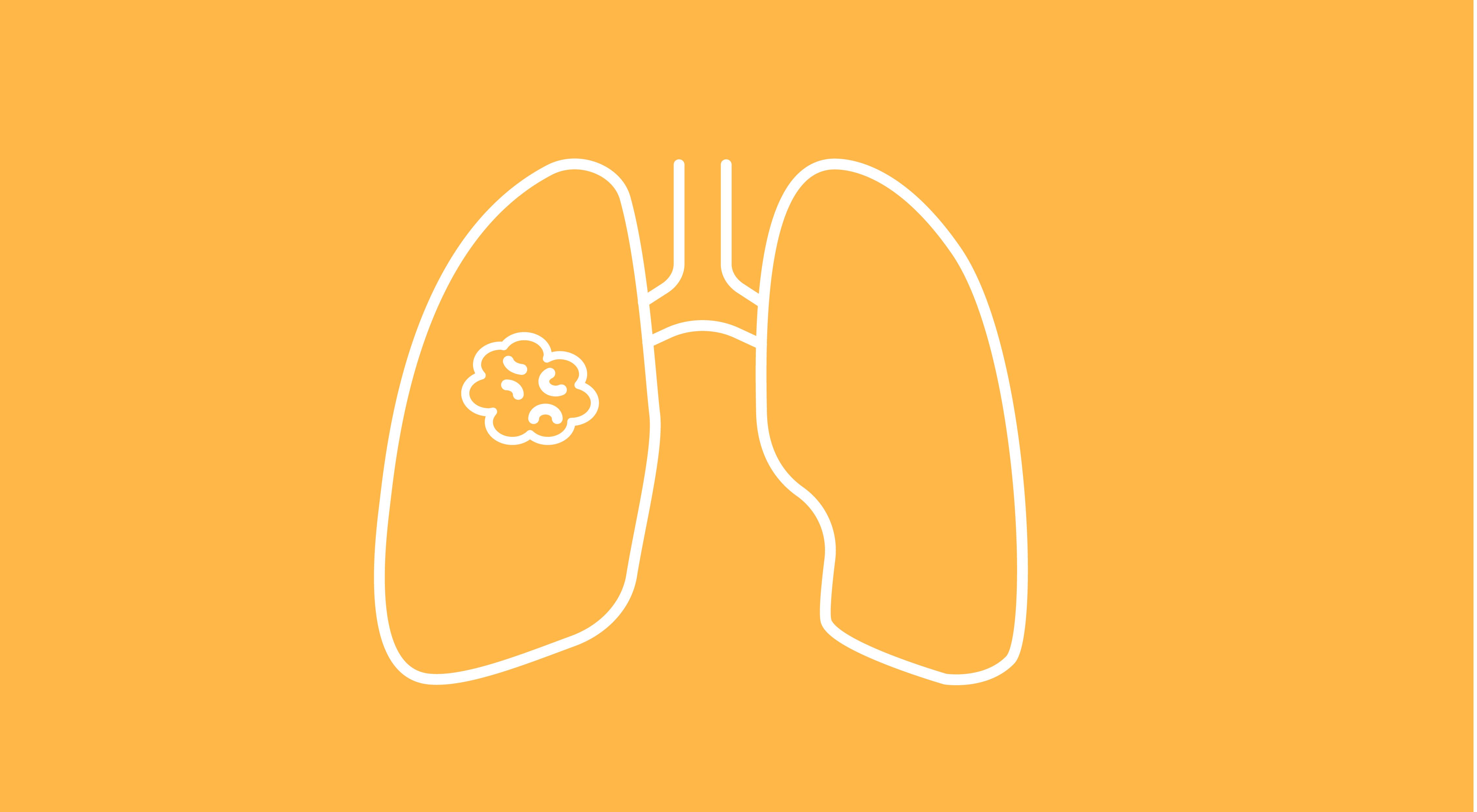 Neoadjuvant, Adjuvant Nivolumab Improve EFS In Resectable NSCLC