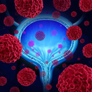 Webinar: Advanced Bladder Cancer