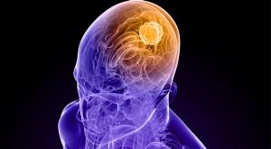 New Combo May Treat Rare Brain Tumor