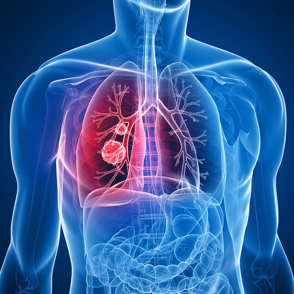 Graphic of a person with tumors in their right lung