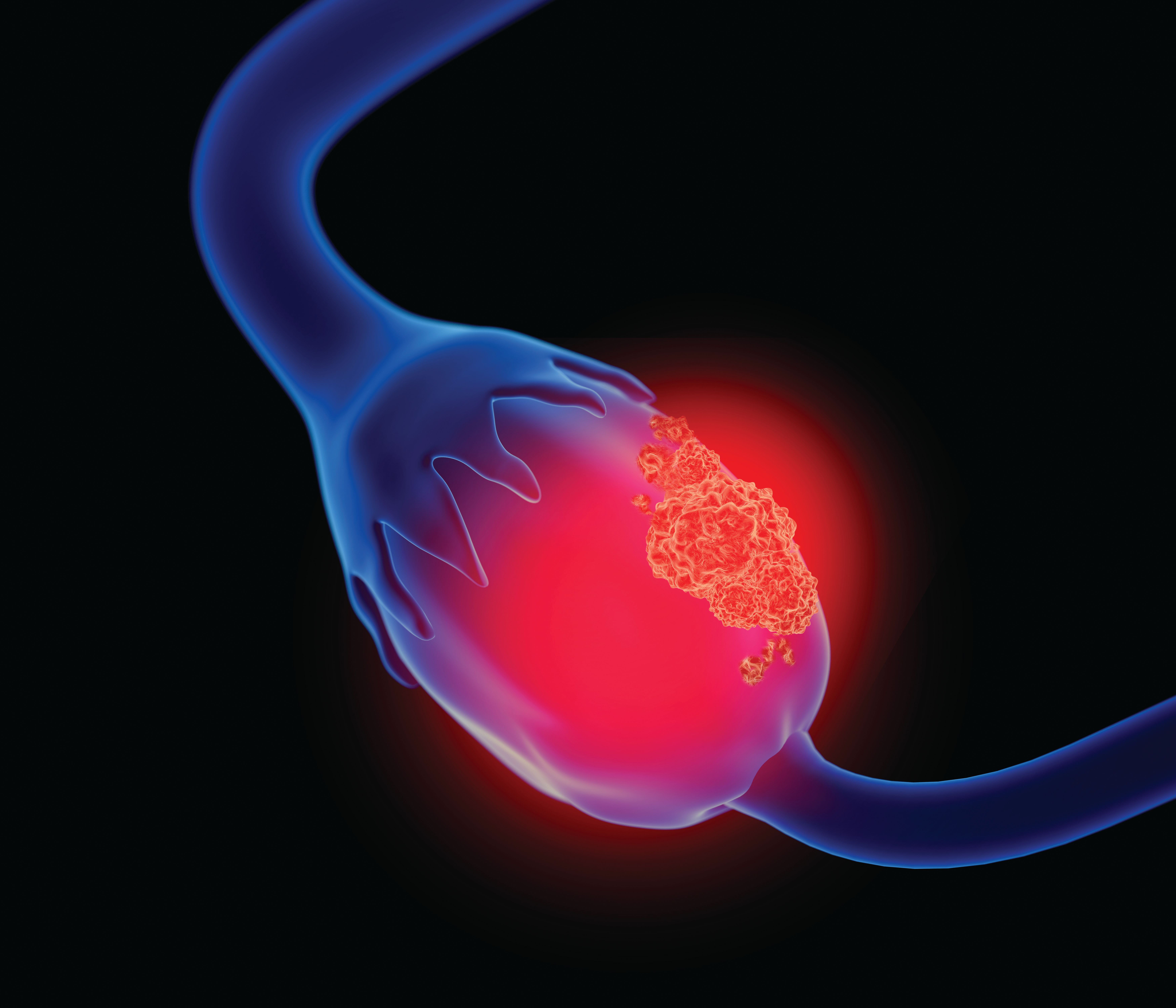 Close-up blue visual of an ovary with a tumor highlighted in orange