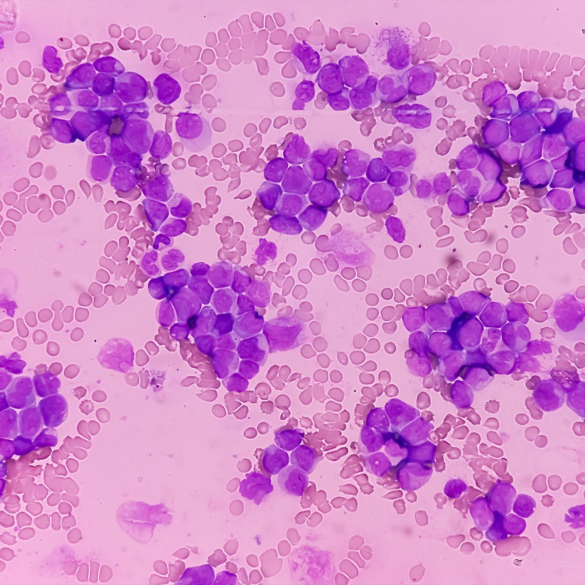 Race Identified as Prognostic Indicator in Black Patients With AML |  Oncology Nursing News