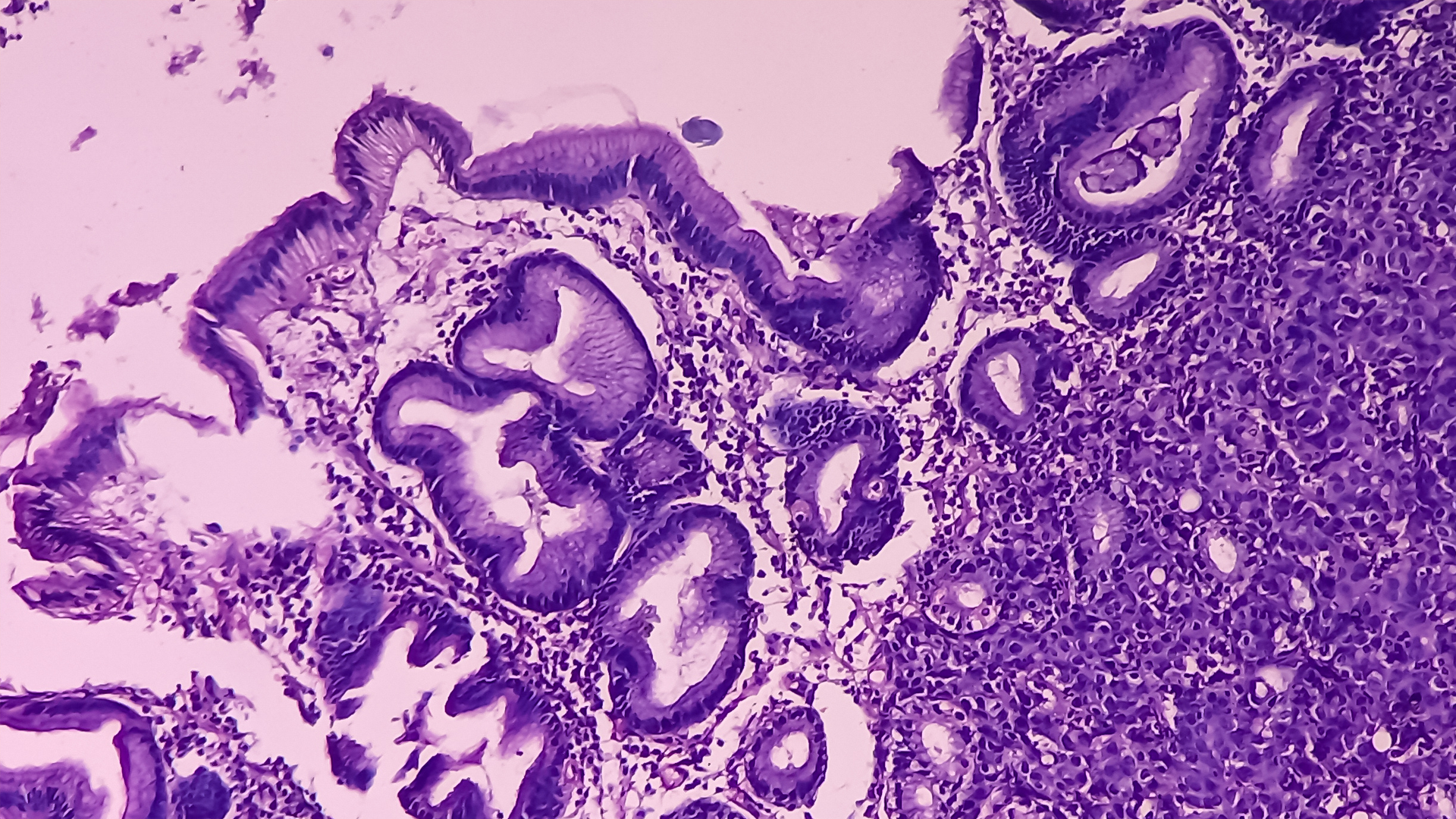 Neuroendocrine Tumors