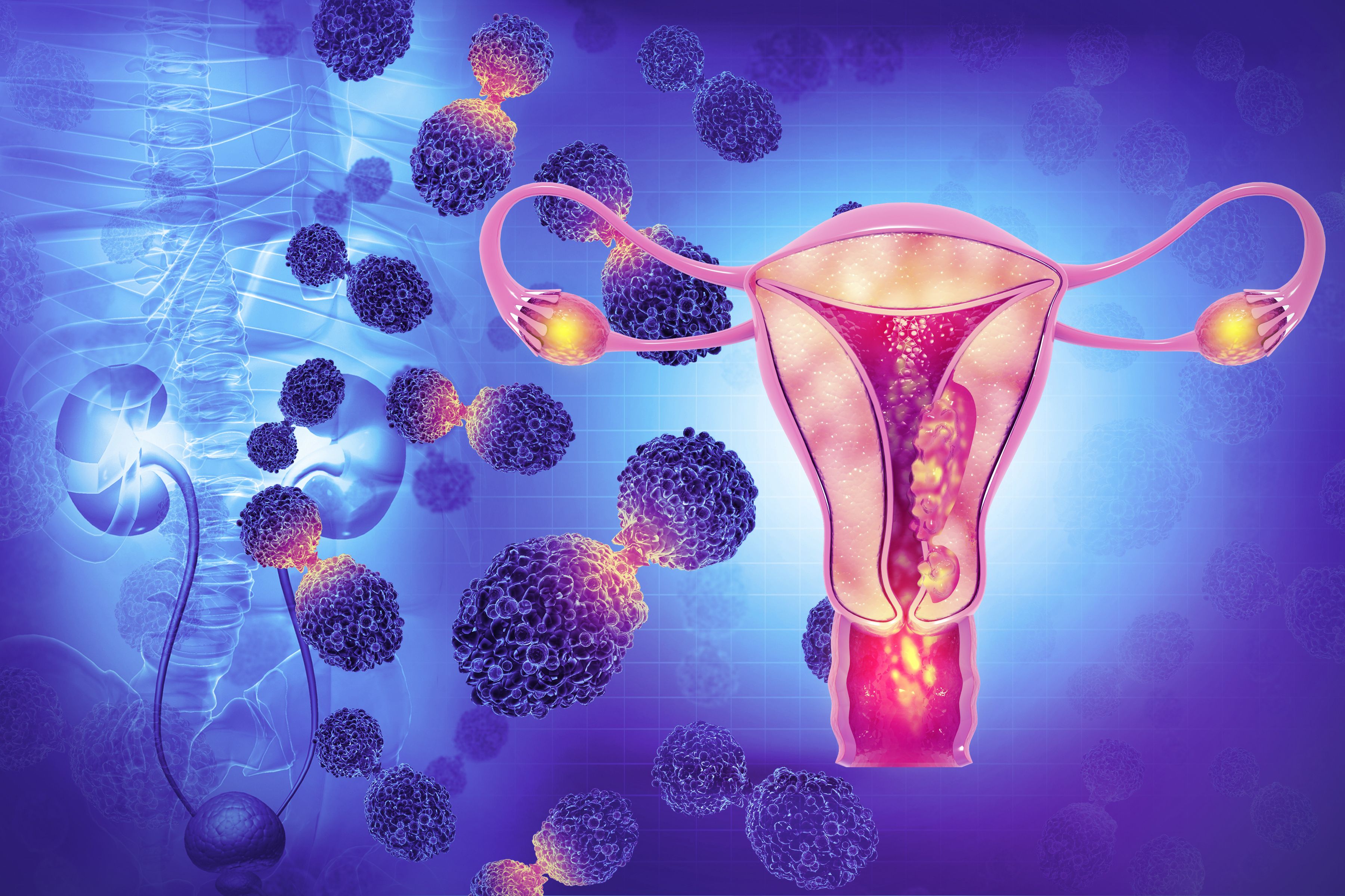 gynecologic cancer