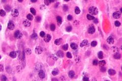 EP. 1 Advancing Multiple Myeloma Treatment With CAR T-Cell Therapy