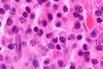 Microscope image of multiple myeloma