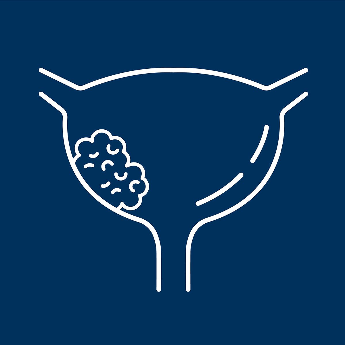 Line illustration of a bladder with a tumor on a dark blue background