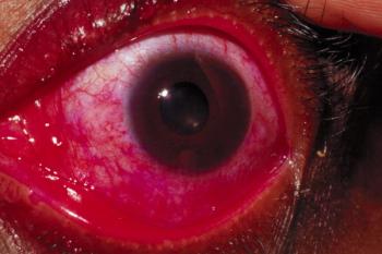 Risuteganib for DED: Promising treatment with increased TBUT, low staining scores