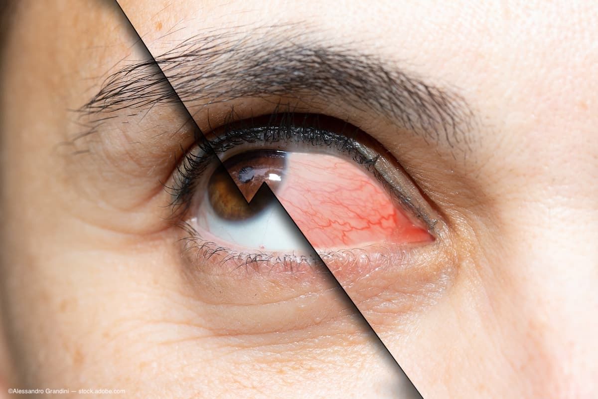 Surgical innovation in dry eye disease: Salivary gland transplant