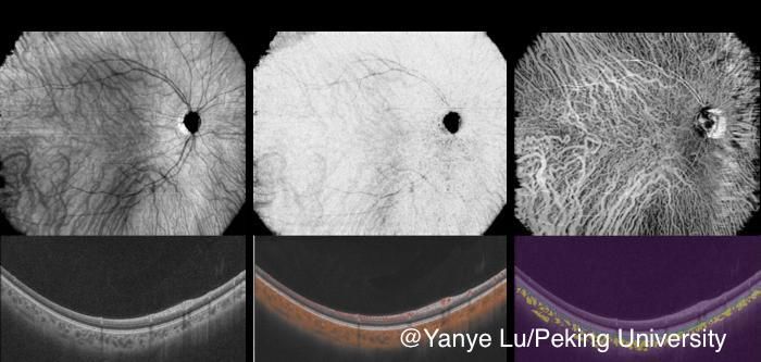 Noninvasive choroidal vessel analysis using deep learning: A novel approach to OCT angiography